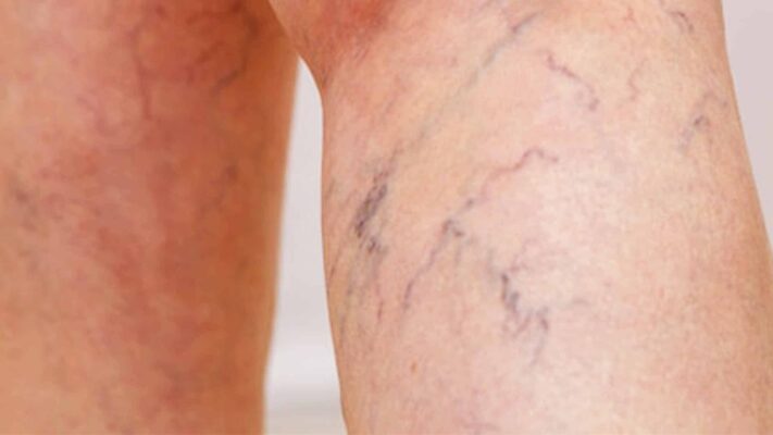 varikoz ven hastalığı