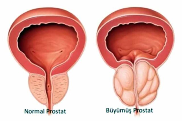 ameliyatsız prostat tedavisi